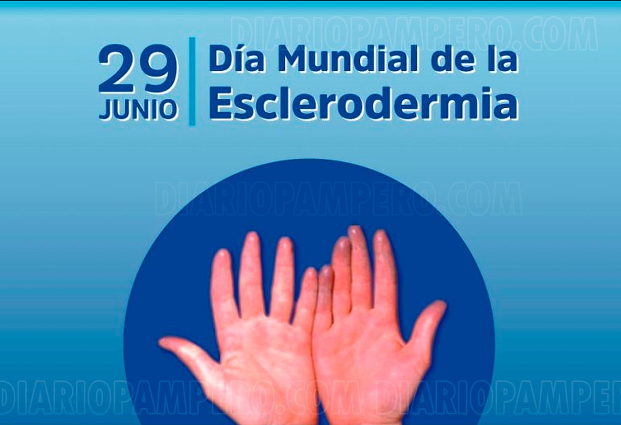 esclerodermia