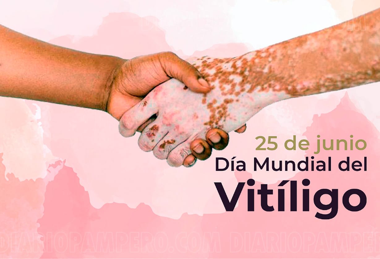 vitiligio