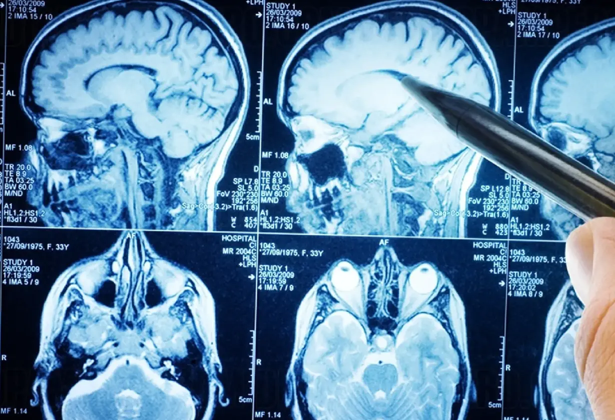 cerebro