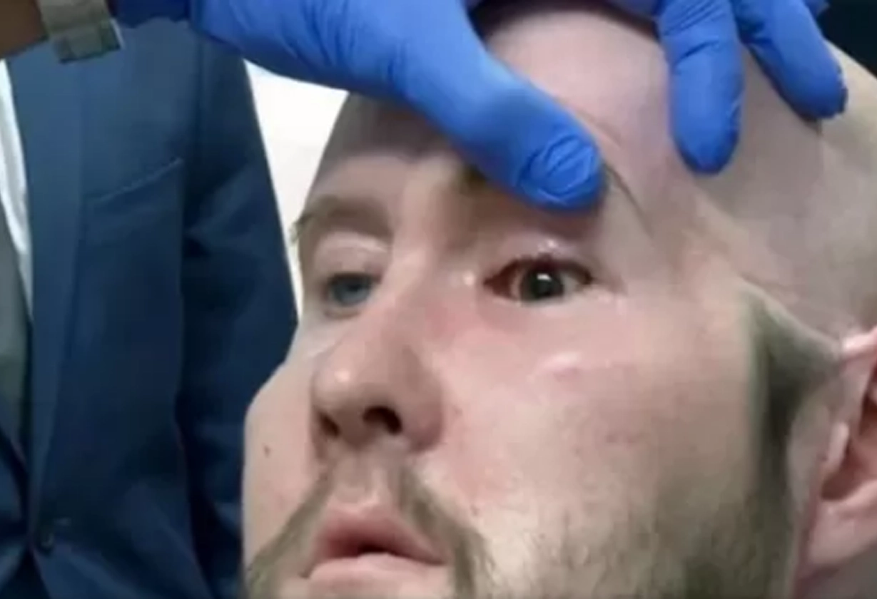 transplante_ojo
