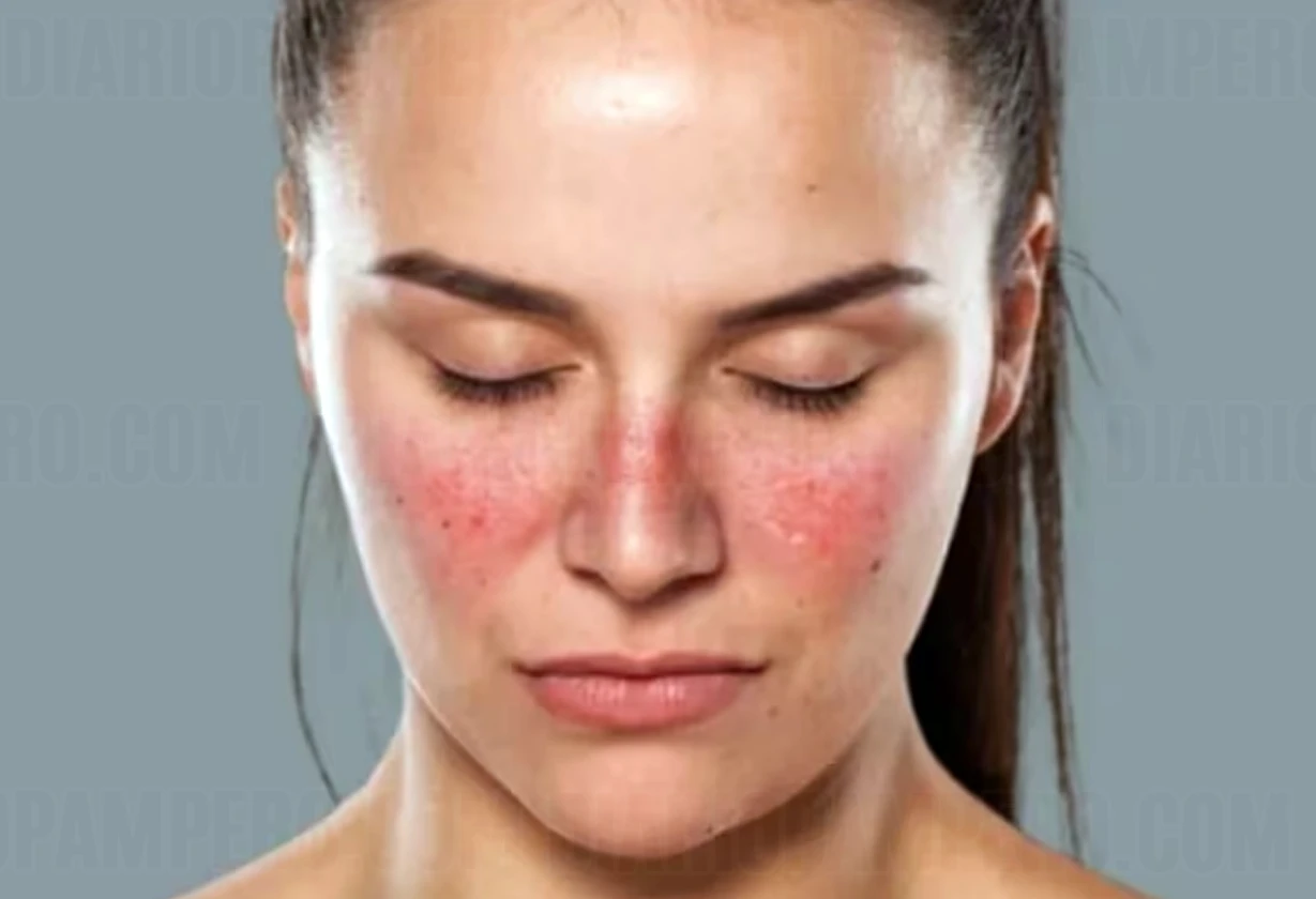 lupus