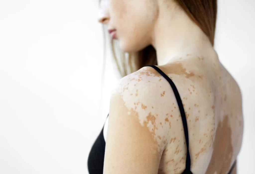 Día Mundial del Vitiligo: A quiénes Afecta, Cuál es el Origen y Cómo se Trata