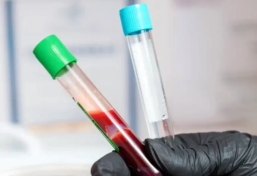 Nuevas Pruebas de Sangre para Diagnosticar el Alzheimer