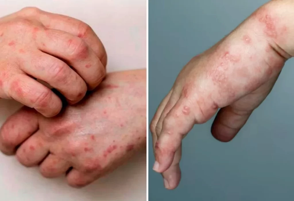 Viruela Símica y Herpes Zóster: Diferencias Clave y Contexto Epidemiológico