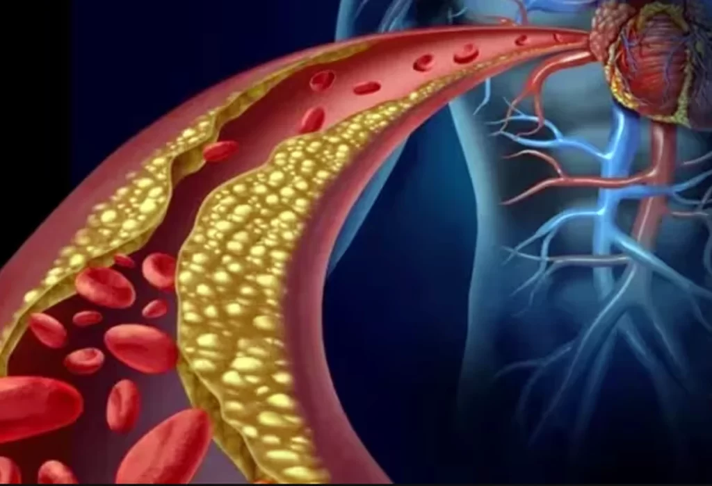 Colesterol alto: Síntomas, riesgos y cómo prevenir enfermedades cardiovasculares
