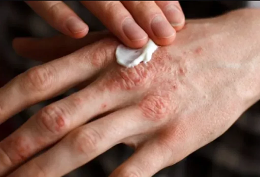 Día Mundial de la Psoriasis: Un Llamado a la Conciencia y el Acceso a Tratamientos