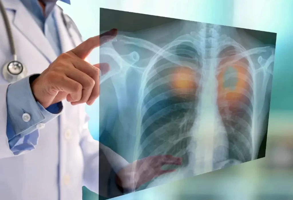 Día Mundial del Cáncer de Pulmón: el desafío de la detección temprana en Argentina