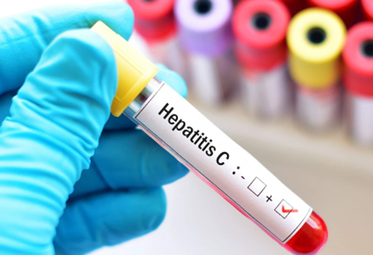 hepatitis